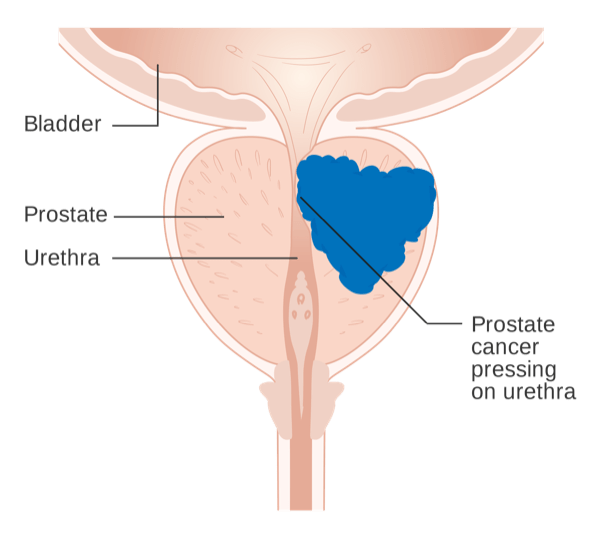 Cancro della Prostata Che Preme Sull'Uretra